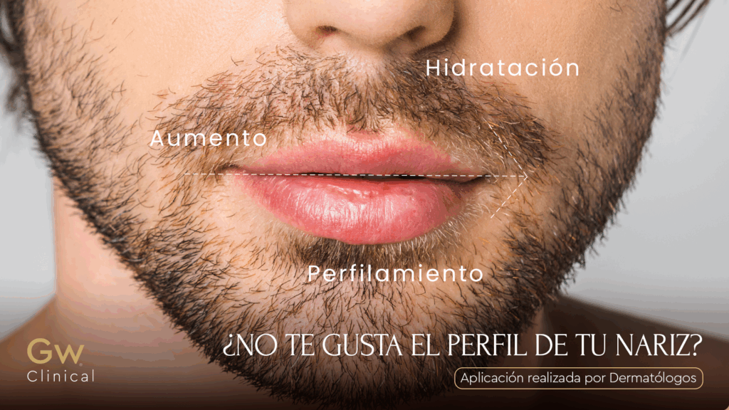 Acido en Labios acido hialuronico en labios ácido hialurónico labios precio acido hialuronico en los labios ácido hialurónico en labios precio acido hialuronico en labios cuanto dura acido hialuronico labios duración aumento de labios con ácido hialurónico mejores clínicas para ácido hialurónico labios tratamiento ácido hialurónico labios profesionales dermatologos ácido hialurónico labial resultados dosis requeridas cuánto dura el ácido hialurónico en labio